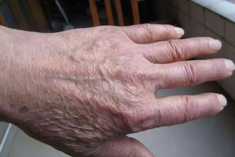 光老化手背皮肤粗糙图