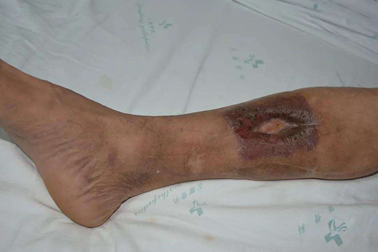 中医阴疽溃烂图 中医阴疽溃烂图