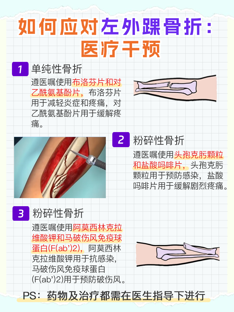 左外踝骨折如何处理？治疗方法一览