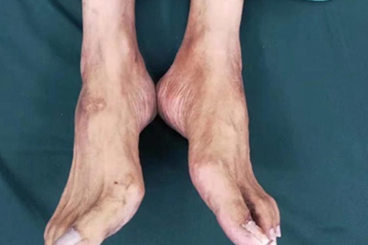 糖尿病性皮肤病斑图