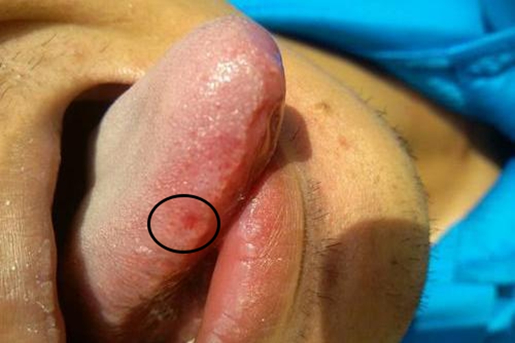 复发性口疮初期图