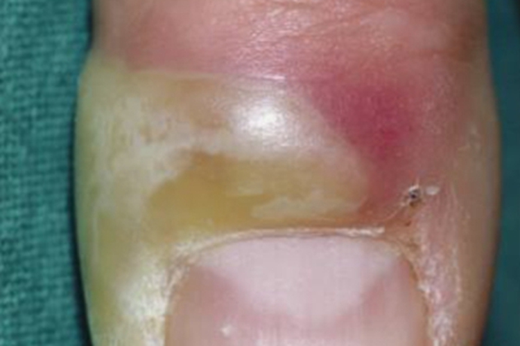 脓性指头炎手指红肿脓包图 脓性指头炎手指红肿脓包图