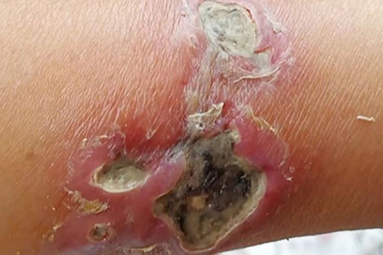 糖尿病性皮肤病胳膊化脓图