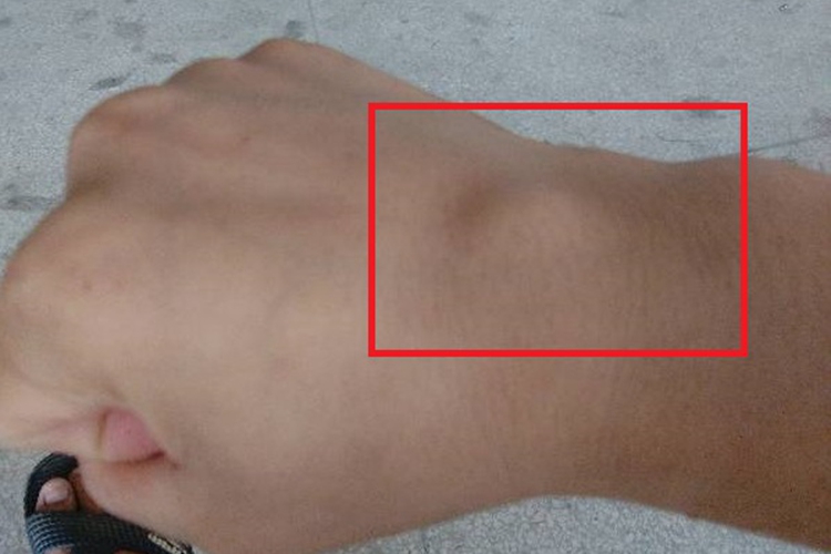 多形性脂肪瘤手腕软疙瘩图 多形性脂肪瘤手腕软疙瘩图