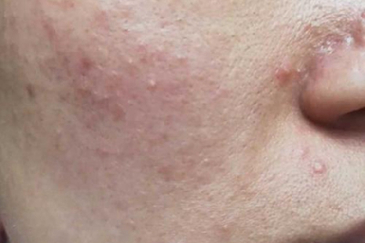 丘疹脓疱型玫瑰痤疮面部小疙瘩图