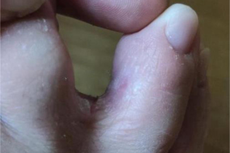 糜烂型足癣脚趾缝轻微脱皮图 糜烂型足癣脚趾缝轻微脱皮图
