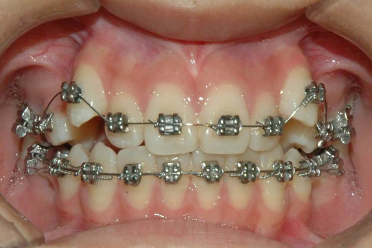 佩戴方丝弓托槽位置图