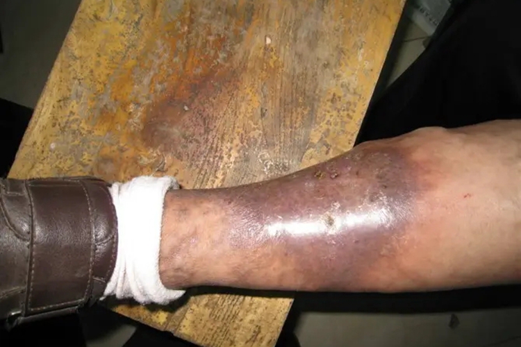 血栓性静脉炎图