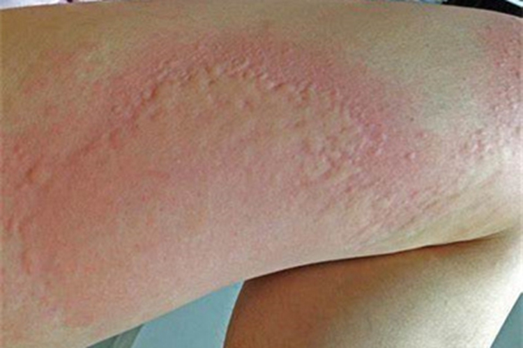 乙型肝炎抗原血症大腿症状图 乙型肝炎抗原血症大腿症状图