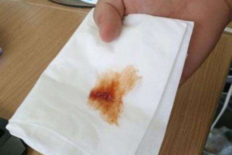 大叶性肺炎铁锈色痰图