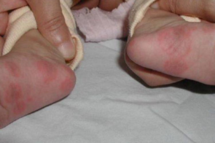 多形红斑型药疹脚底红斑图 多形红斑型药疹脚底红斑图