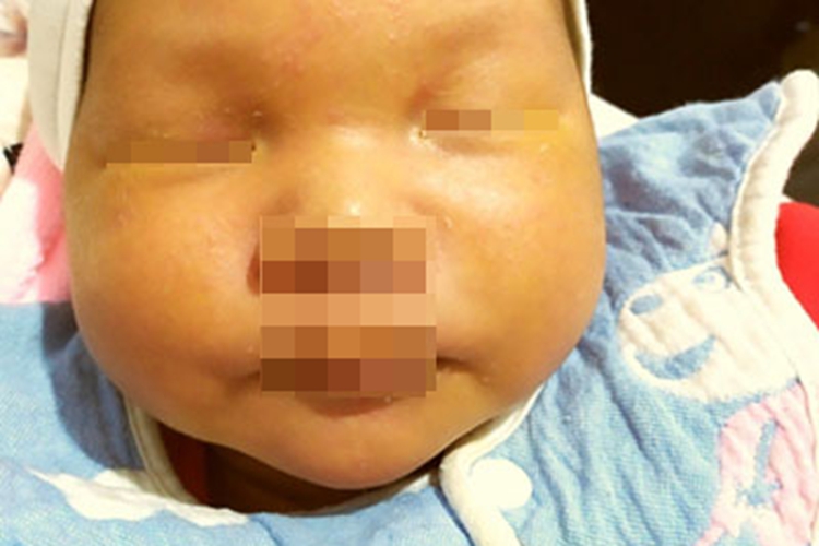 急性新生儿核黄疸面部皮肤发黄图 急性新生儿核黄疸面部皮肤发黄图