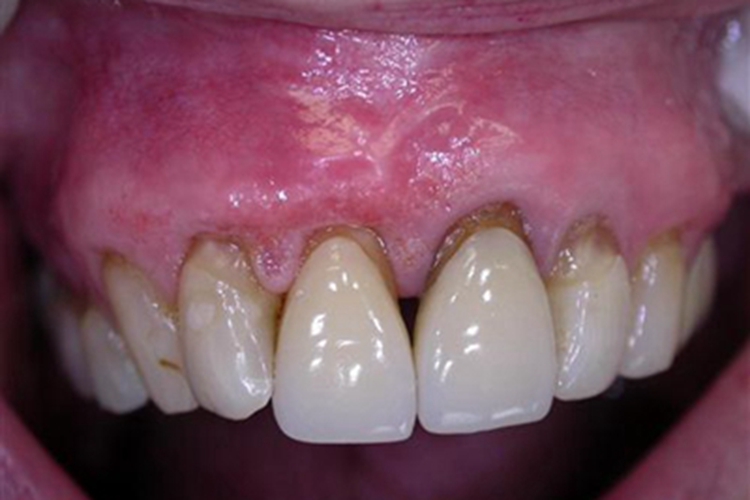 牙龈萎缩牙龈肿胀明显图