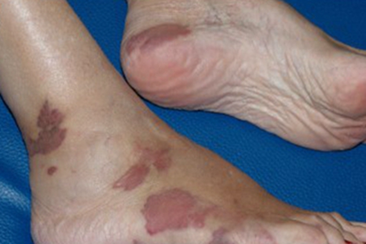 卡波西肉瘤起红斑图