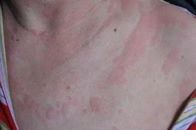 冷接触性荨麻疹胸部风团图