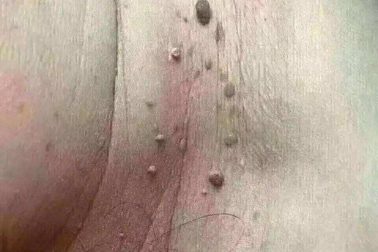 腋窝下扁平疣图