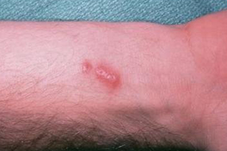 猫抓病手臂上起丘疹图