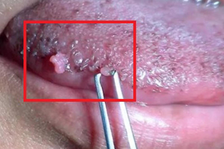 男性尖锐湿疣口腔肉粒图