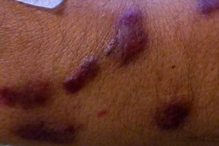 卡波西肉瘤起红斑图