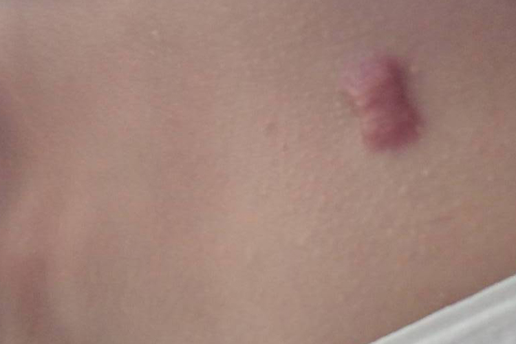 水痘留下的瘢痕疙瘩图