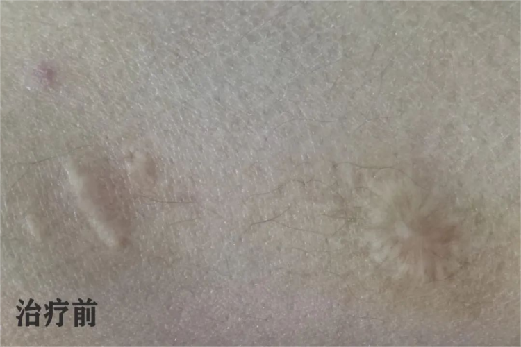 烟疤手术前图 烟疤手术前图