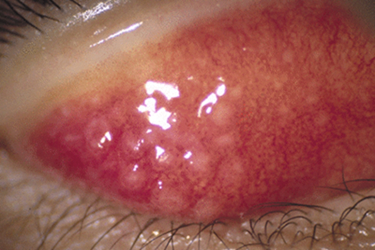 流行性角结膜炎结膜有水疱图 流行性角结膜炎结膜有水疱图