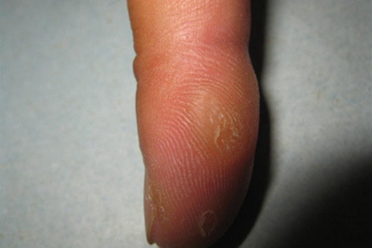 胼胝手指有黄色茧子图