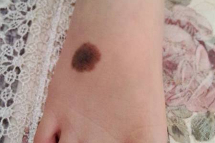 交界痣脚背症状图 交界痣脚背症状图