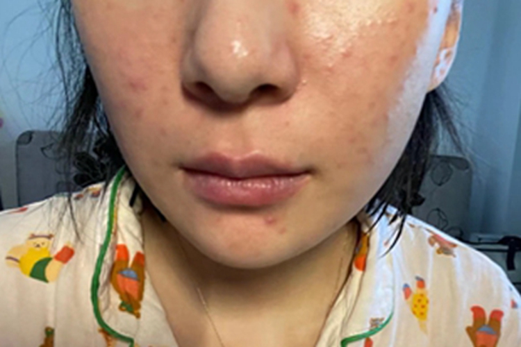 油痤疮面颊起红疹子图