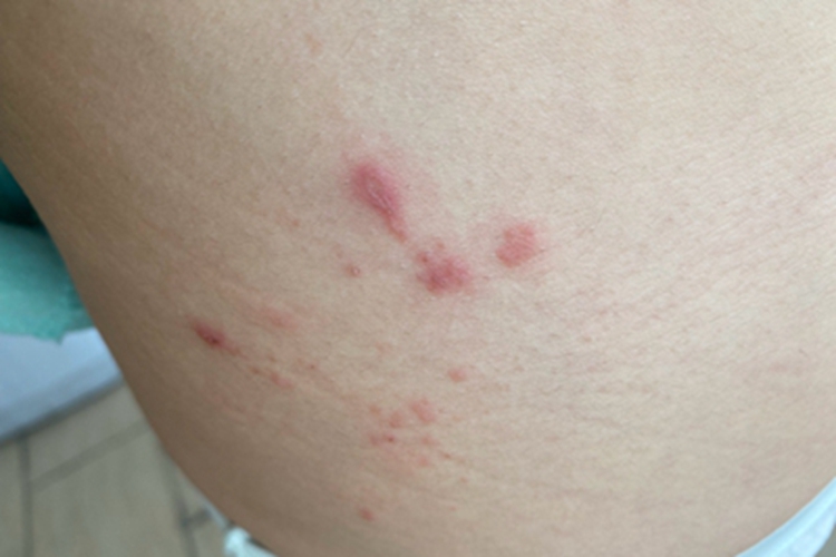 接触性皮炎腰部丘疹图