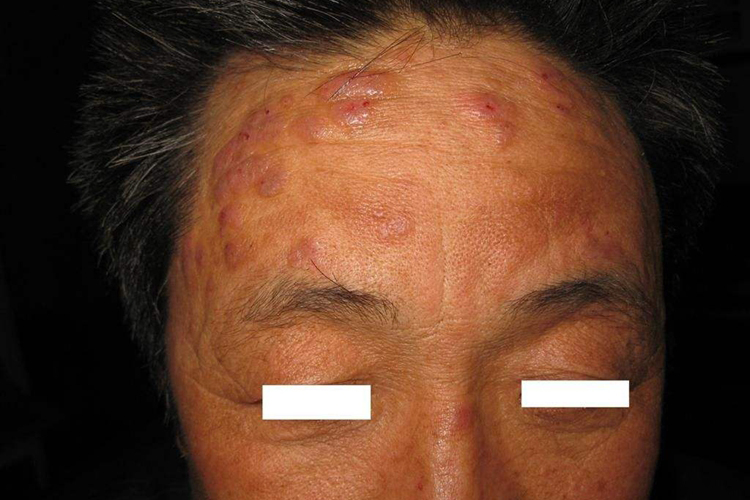 结节性痒疹脸上长结节图