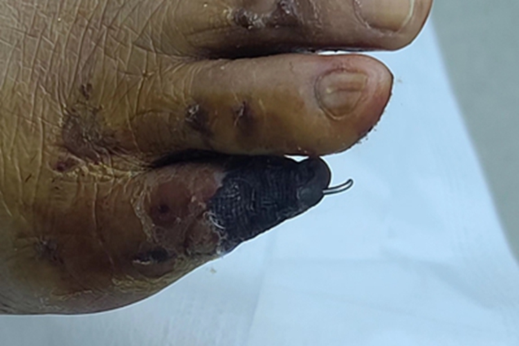 外伤脚趾皮肤变黑坏死图