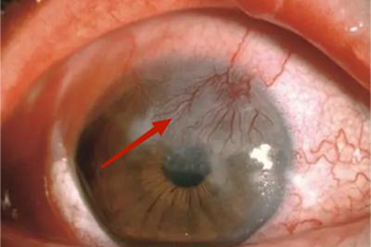 带状角膜病变结膜血丝图 带状角膜病变结膜血丝图