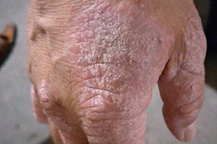 更年期角皮症手部症状图
