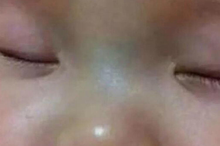 新生儿窒息皮肤青紫图
