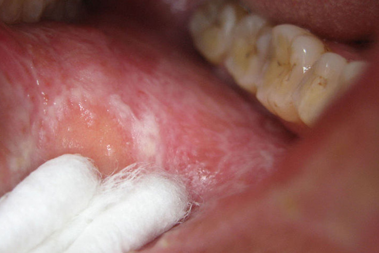 扁平苔藓口腔黏膜白斑图 扁平苔藓口腔黏膜白斑图