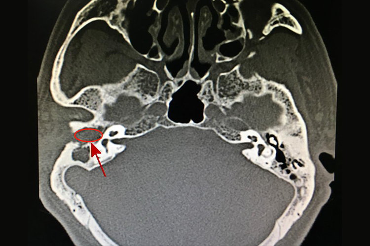 胆脂瘤CT图 胆脂瘤CT图