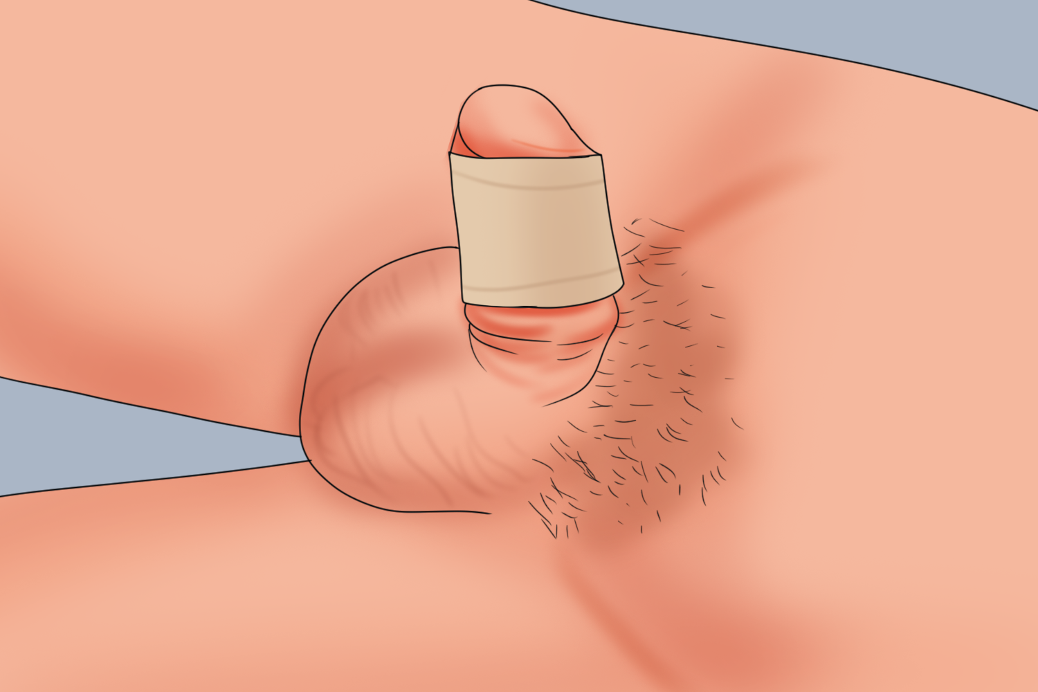 割了包皮后阴茎包裹纱布图 割了包皮后阴茎包裹纱布图