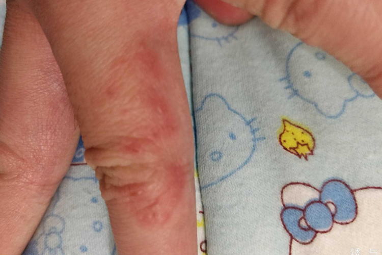 小孩水疱型手癣图