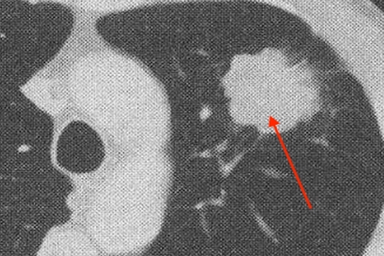 周围型肺癌CT图