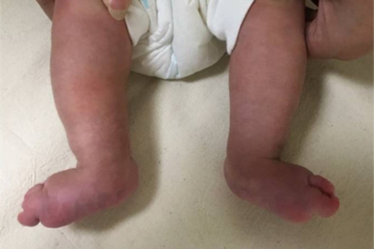 先天性垂直距骨脚部症状图