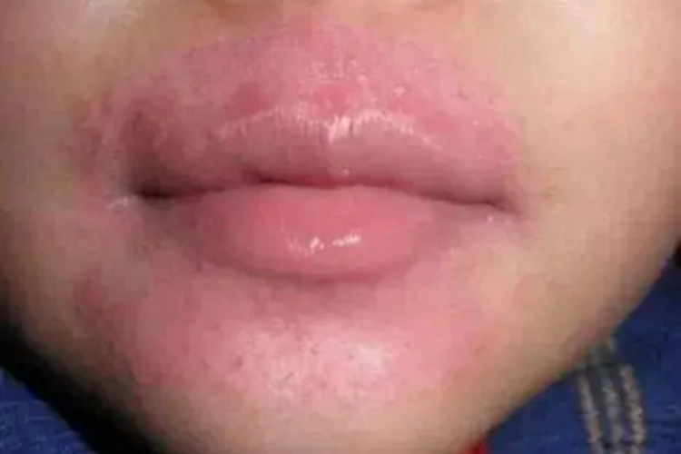 海鲜过敏口周丘疹红斑图 海鲜过敏口周丘疹红斑图