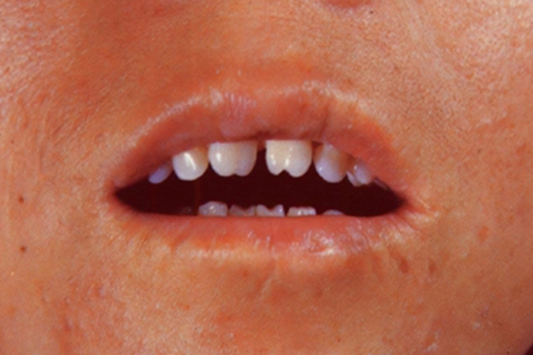 梅毒牙齿半月形的图片图片