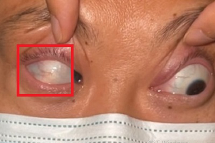 巩膜葡萄肿眼球斑图