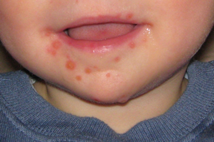 手足口病口周小红疙瘩图