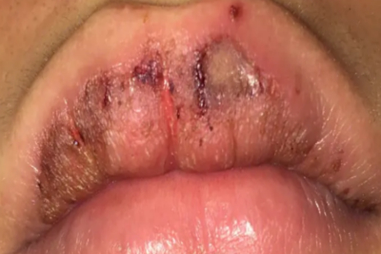 异位皮脂腺结痂图 异位皮脂腺结痂图