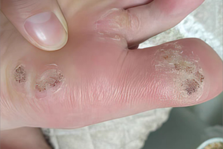 疣脚底皮肤增厚图