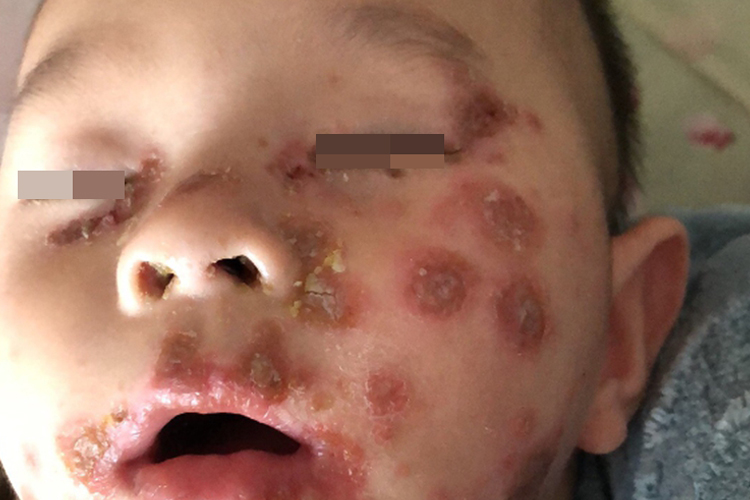 新生儿脓疱疮图 新生儿脓疱疮图