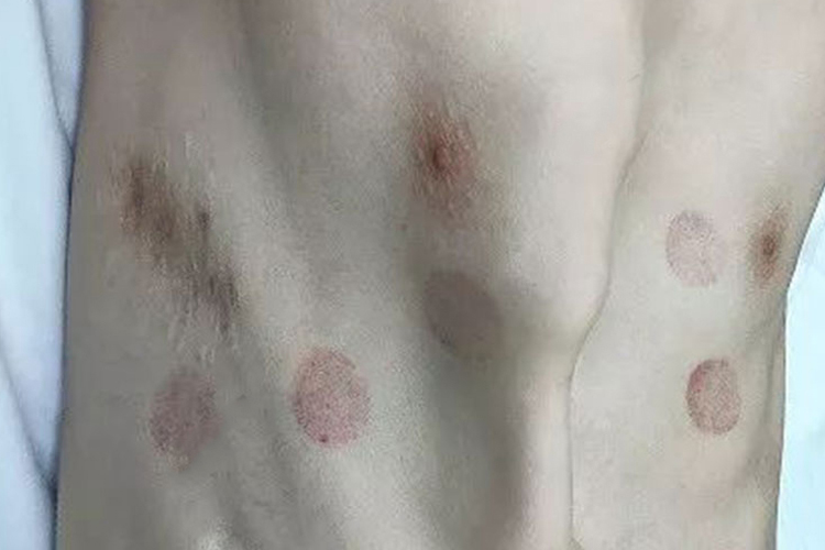 黏多糖贮积病患者鸡胸图