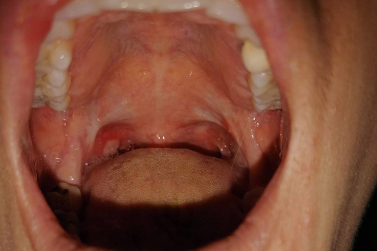 轻型阿弗他溃疡图